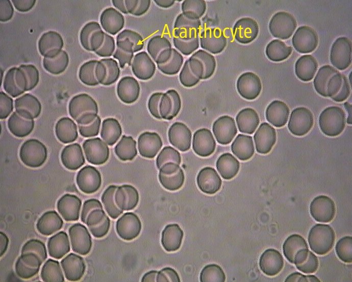 Dark field microscopy showing acanthocytes - red blood cells with irregular thorn-like projections