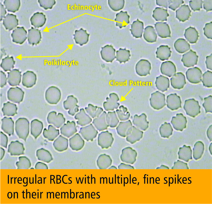 Dark field microscopy showing echinocytes - red blood cells with short evenly spaced spikes
