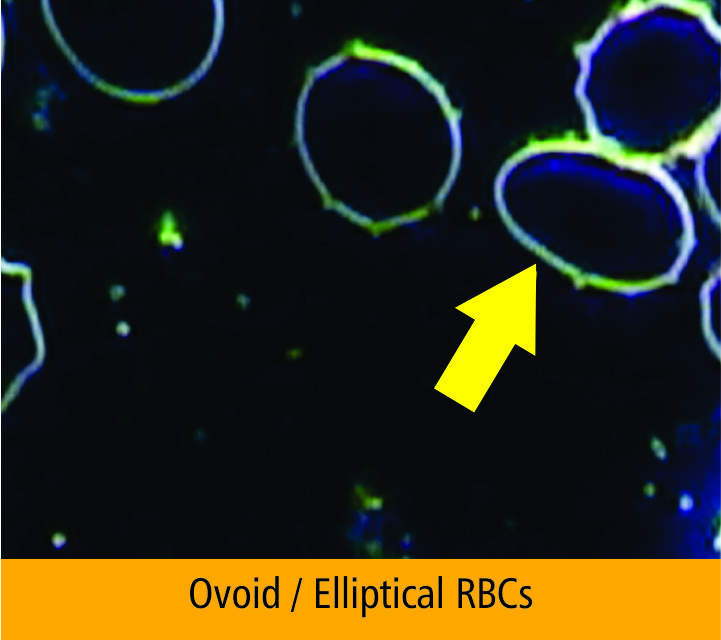 Dark field microscopy showing ovalocytes - egg-shaped red blood cells