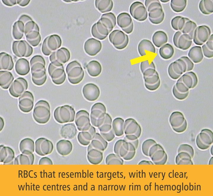 Dark field microscopy showing target cells with bullseye pattern