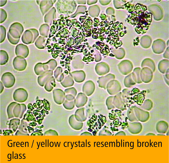 Dark field microscopy showing uric acid crystals in blood plasma